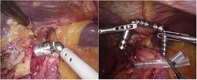 Safety profile of magnetic sphincter augmentation for gastroesophageal reflux disease